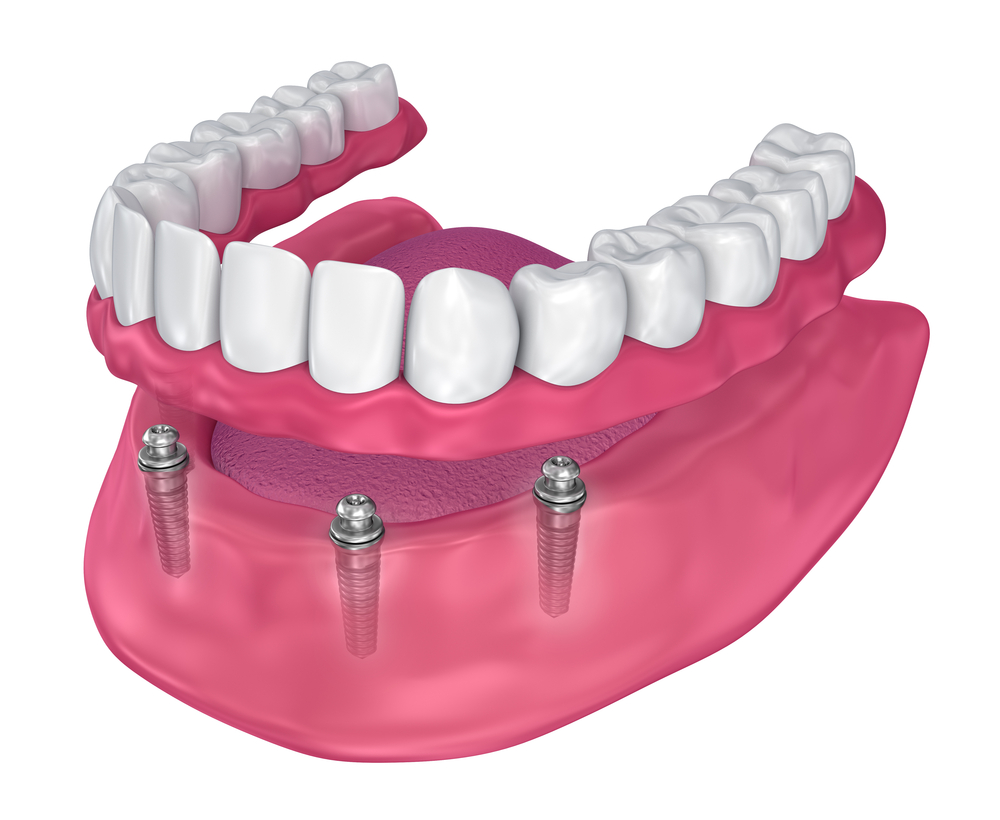 How Many Dental Implants Will I Need for Implant Dentures?