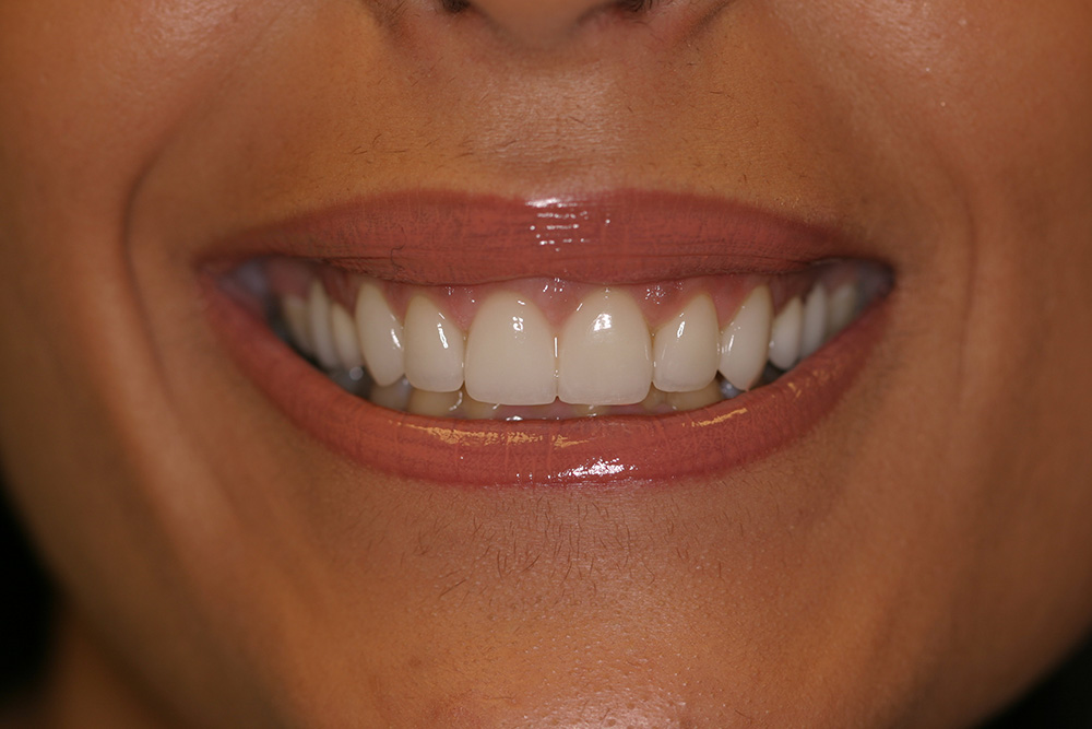 Case255 Restorative and Implant Dentistry of Bayside